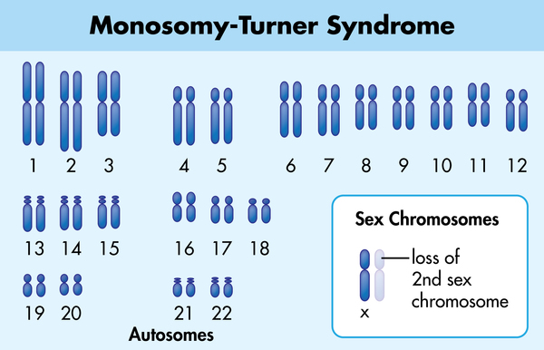 Karyotype of Monosomy